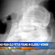 Illustration for article titled This is what a 40-year-old fetus inside a 80-year-old woman looks like
